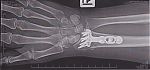 27-9-11 post op2